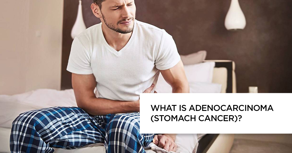 What is Adenocarcinoma (Stomach Cancer)?