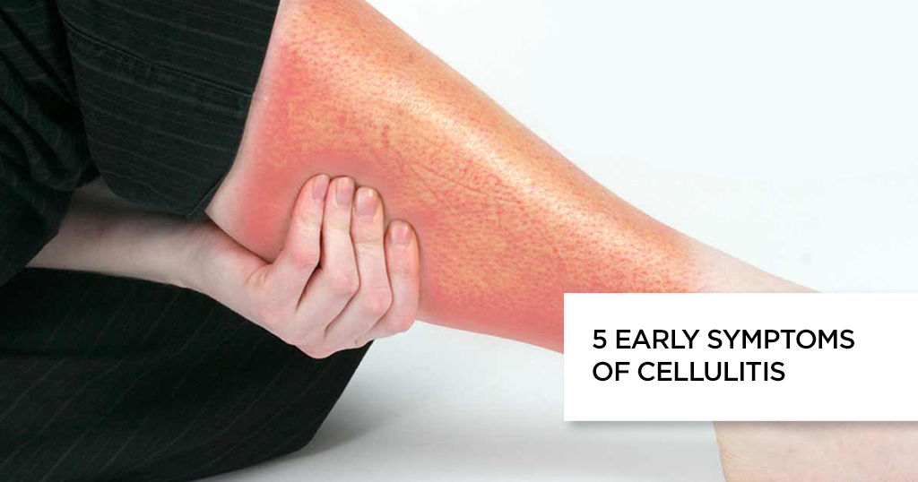 5 Early Symptoms of Cellulitis