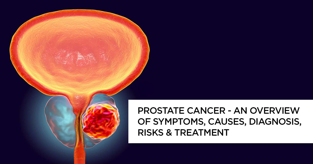 Prostate Cancer – An Overview of Symptoms, Causes, Diagnosis, Risks & Treatment