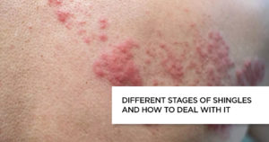 Different Stages of Shingles and How to Deal With it