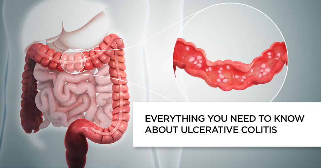 Ulcerative Colitis: Symptoms, Causes and Treatment