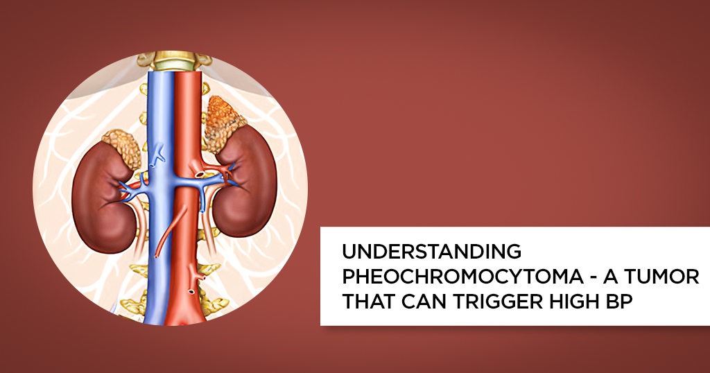 Understanding Pheochromocytoma – A Tumor that can Trigger High BP