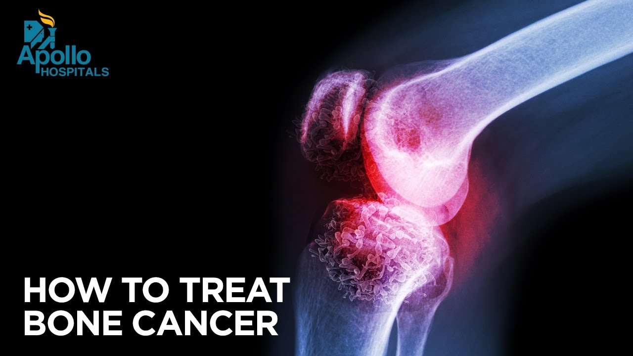 Identifying and managing cancer of the bone| Early Signs of Bone Cancer