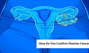 How Do You Confirm Ovarian Cancer?