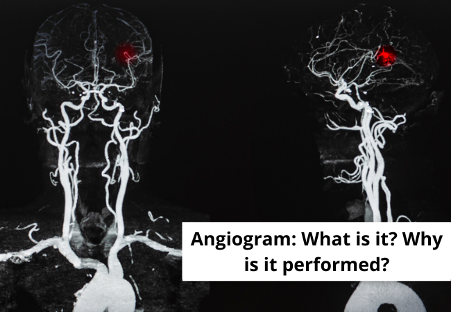 Angiogram: What is it? Why is it performed?