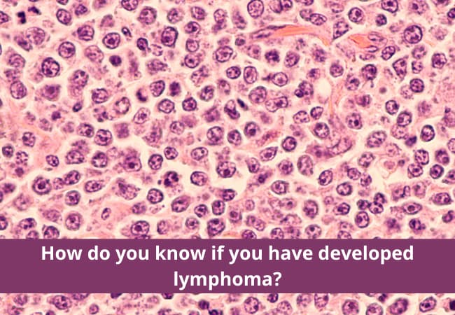 How do you know if you have developed Lymphoma?