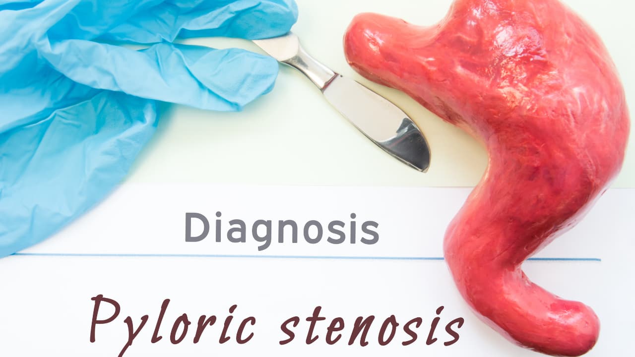 What is Pyloric Stenosis (HPS)? What Are the Symptoms of Pyloric Stenosis?