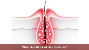 What Are Blocked Hair Follicles?