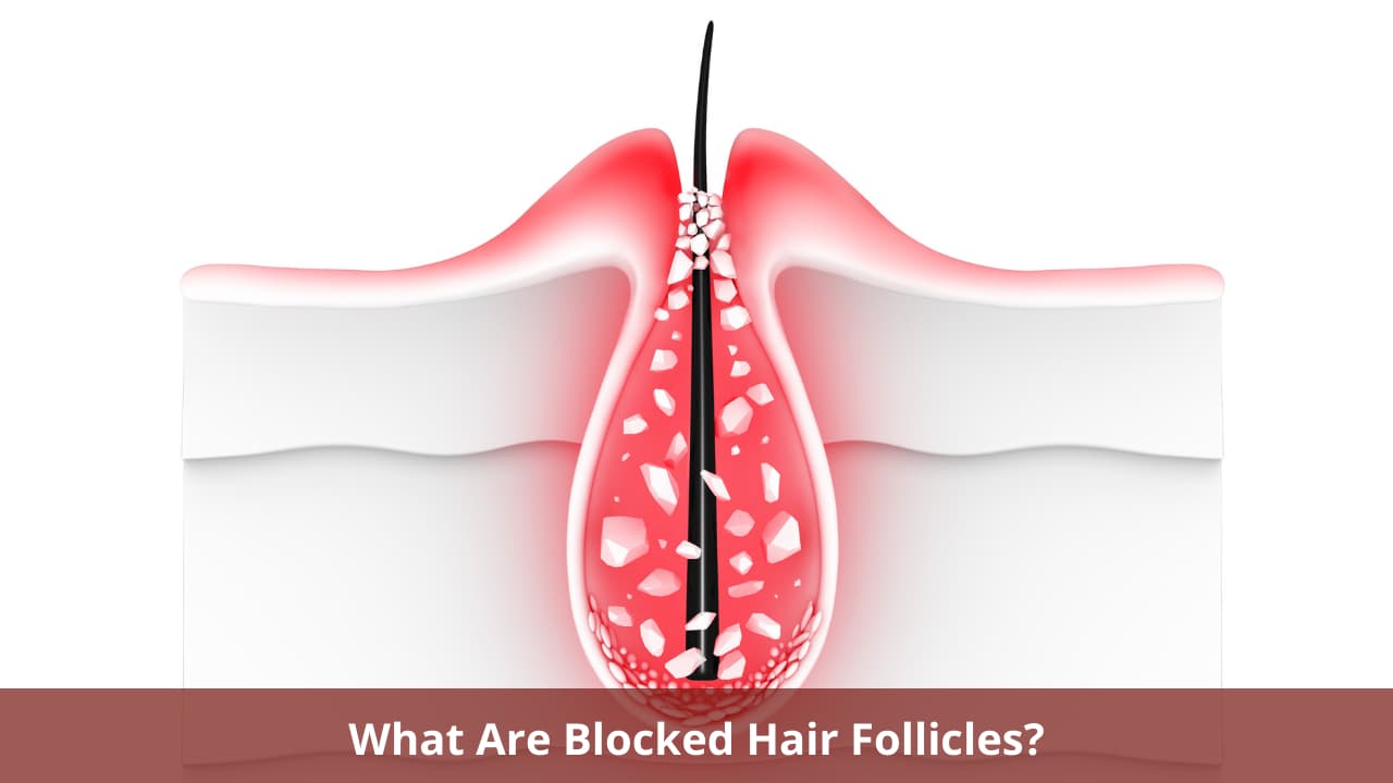 Blocked Hair Follicles