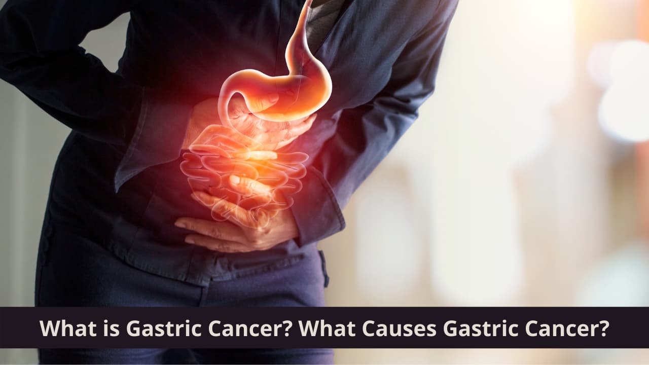 What is Gastric Cancer? What Causes Gastric Cancer?