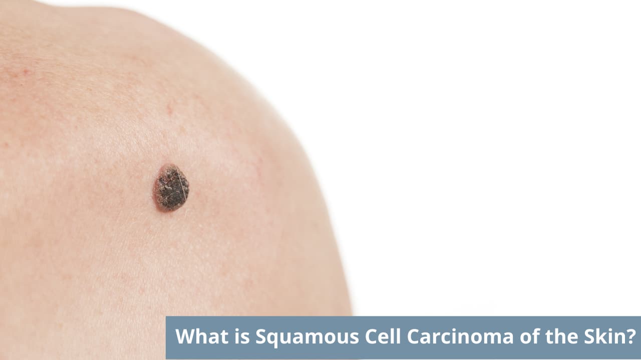 What is Squamous Cell Carcinoma of the Skin?