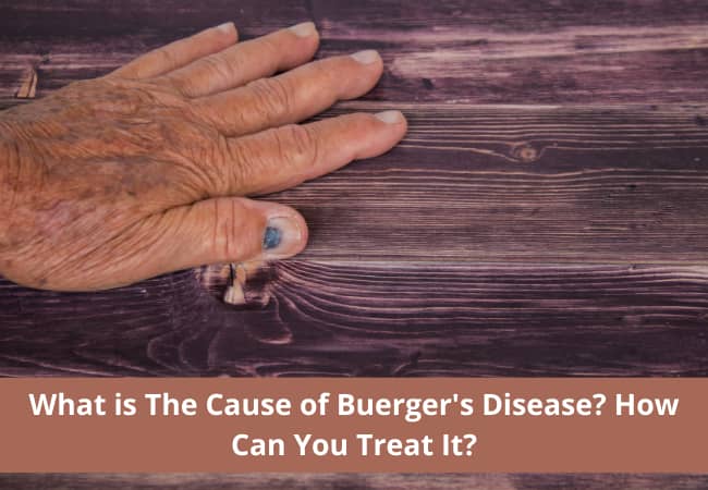 What is The Cause of Buerger’s Disease? How Can You Treat It?