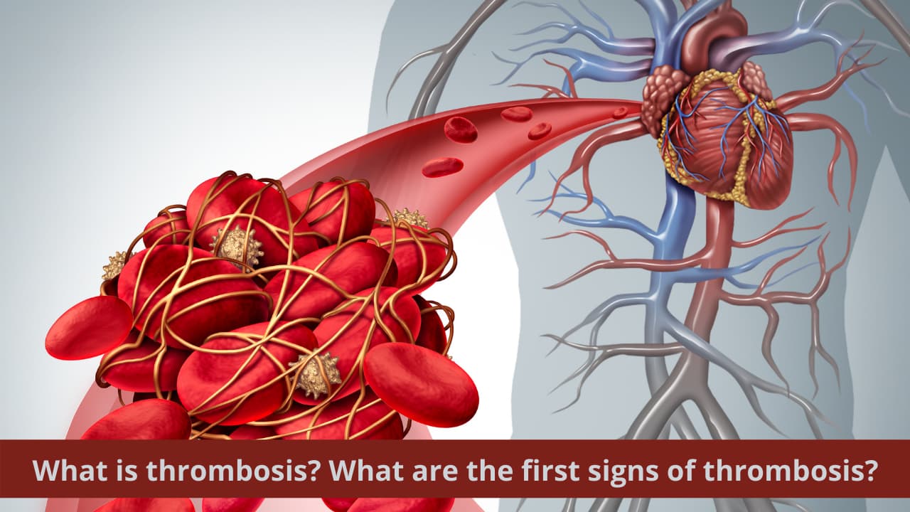 What is thrombosis? What are the first signs of thrombosis?