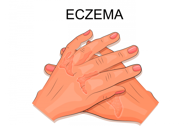 Home Remedies for Eczema