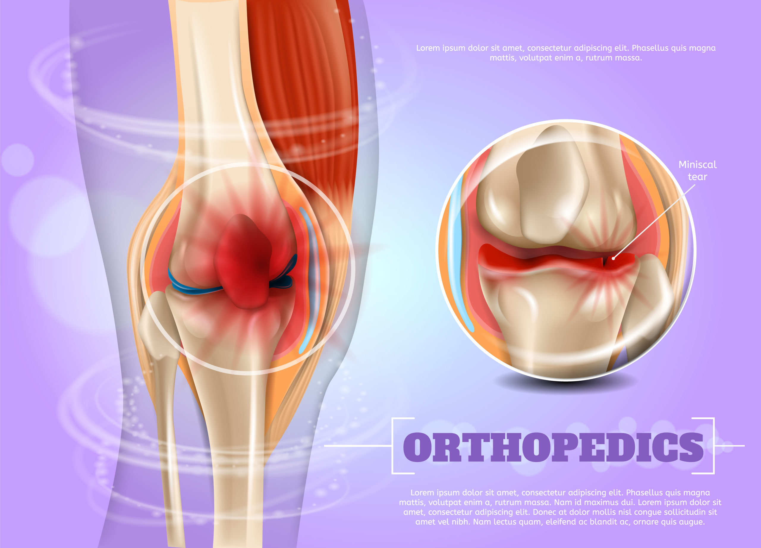 When are Arthroscopies Performed? – Apollo Hospitals Blog