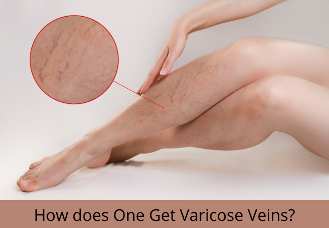 How does One Get Varicose Veins?