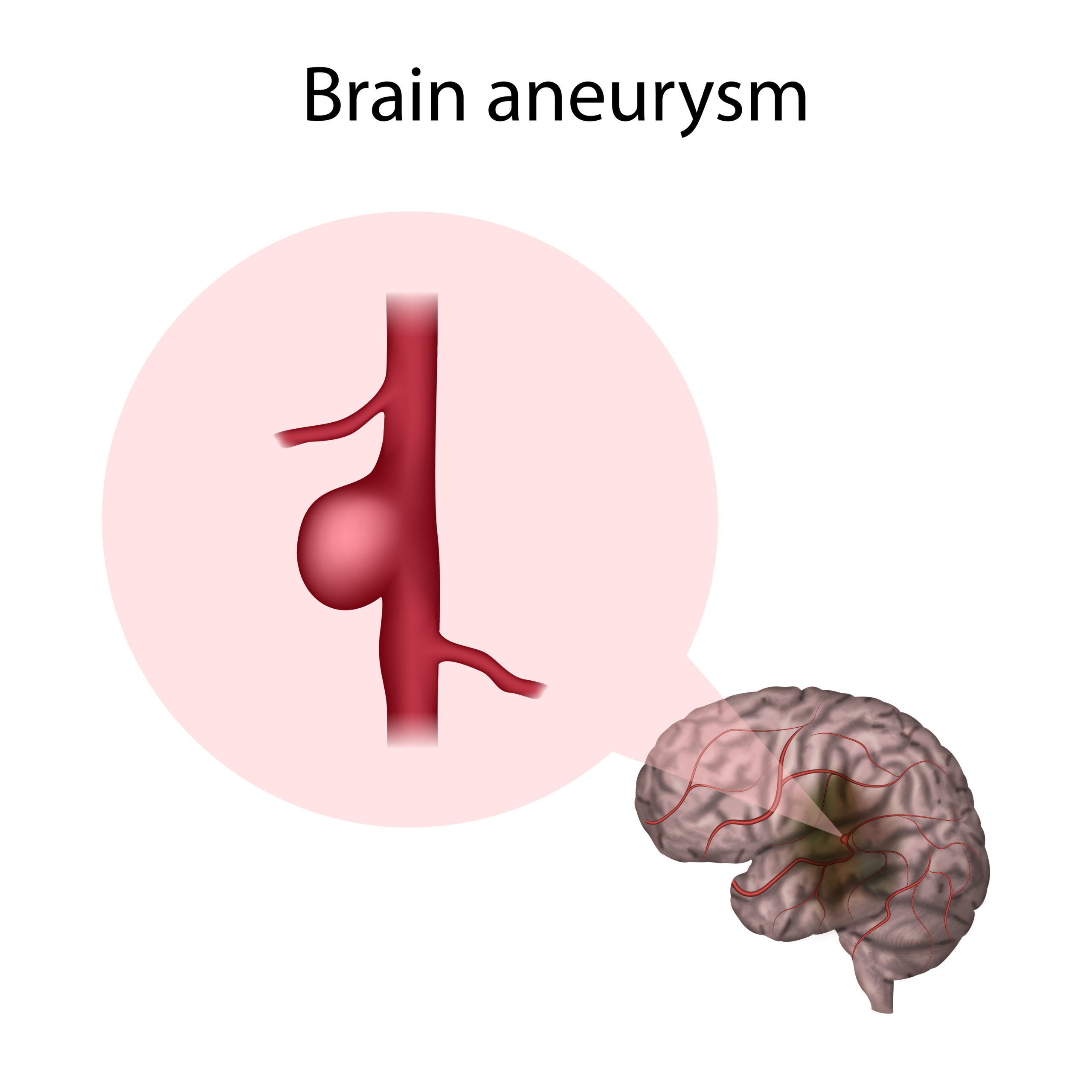 Brain Aneurysms – Types, Causes, Symptoms and Treatment