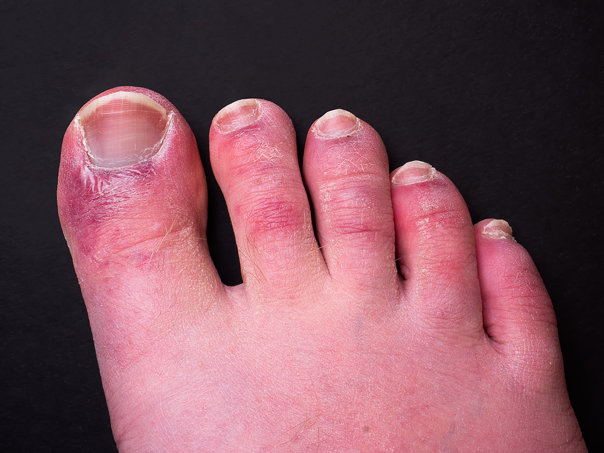 Chilblains: Causes, Symptoms & Treatment