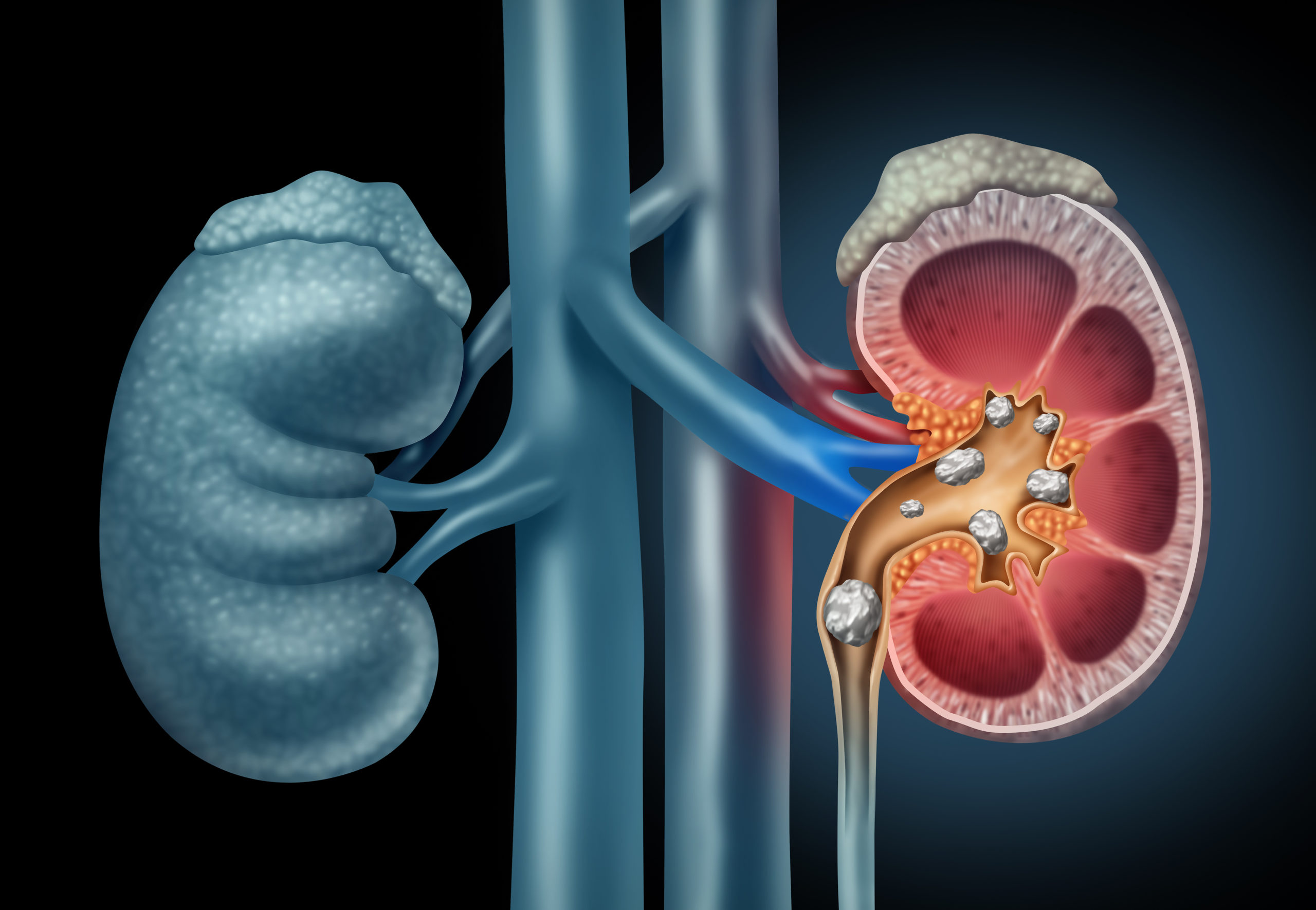 What are the various ways to remove kidney stones?