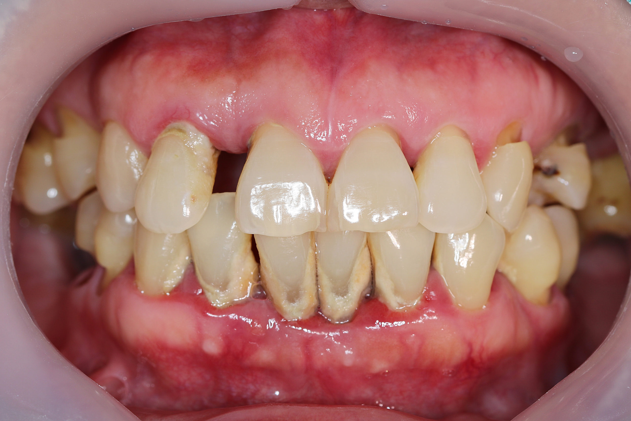 All You Want to Know About Periodontitis