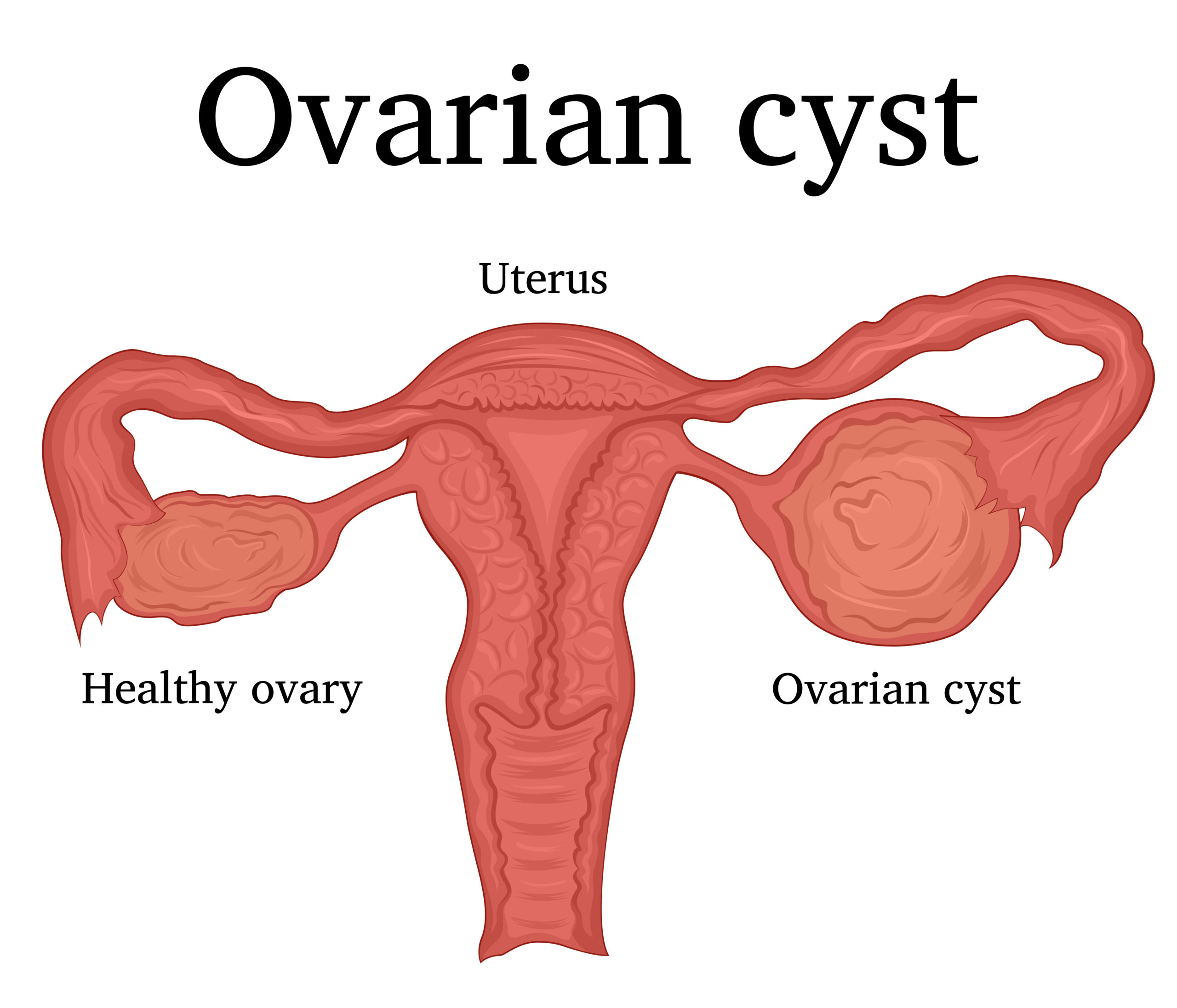 Ovarian Cyst: Causes and Symptoms