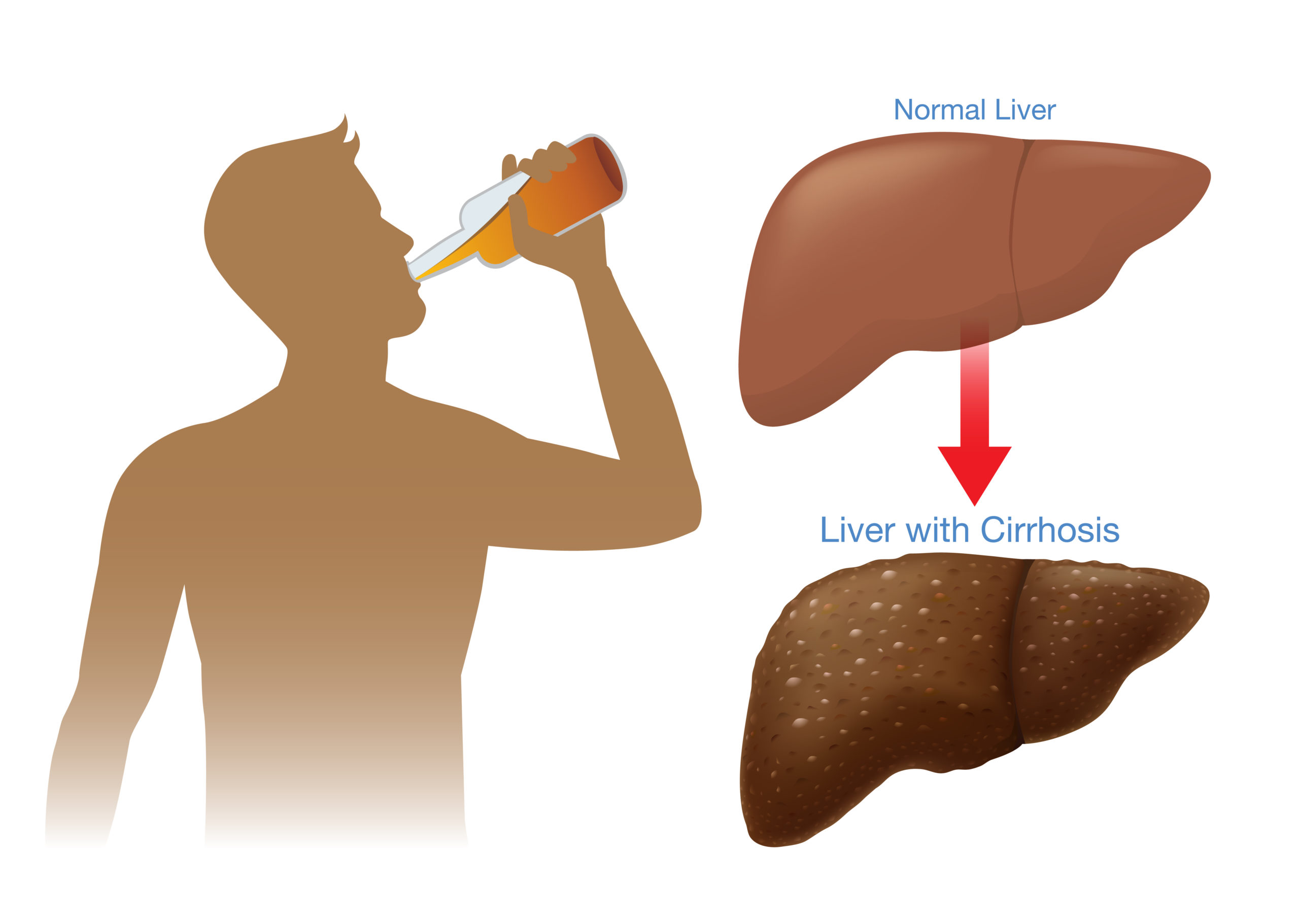 Alcohol Related Liver disease - Early Signs, Treatment and Prevention