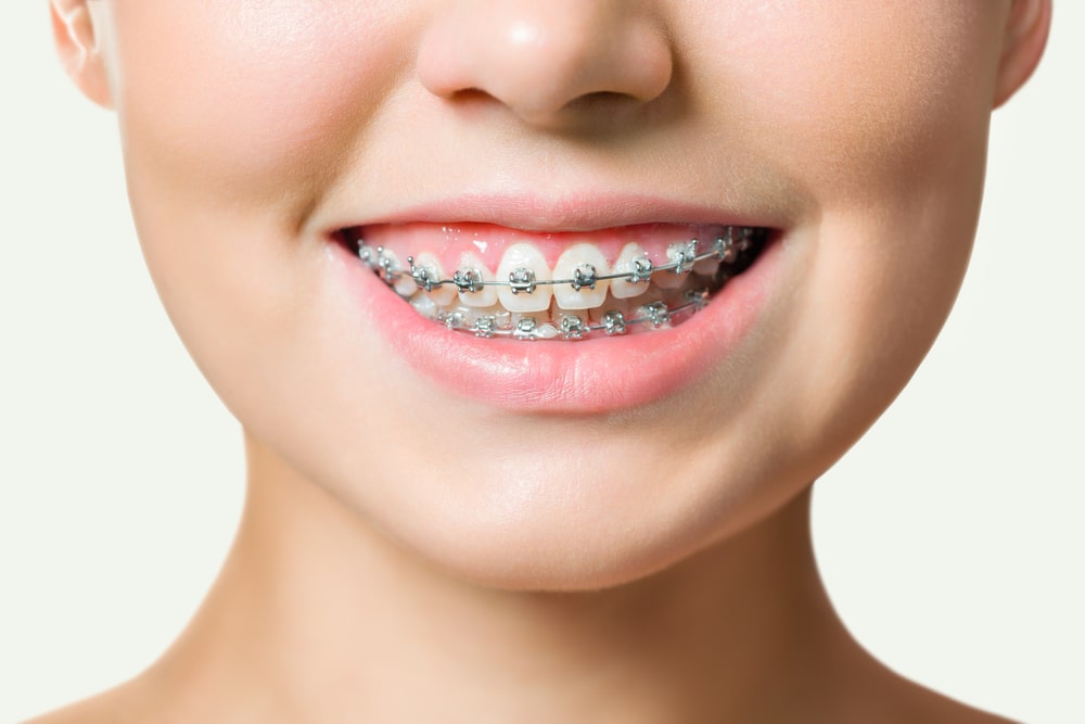 All about Dental Braces