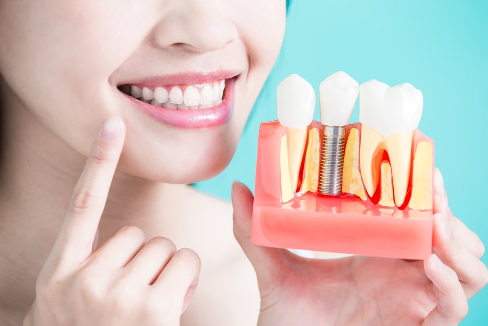 All about Dental Implant Surgery