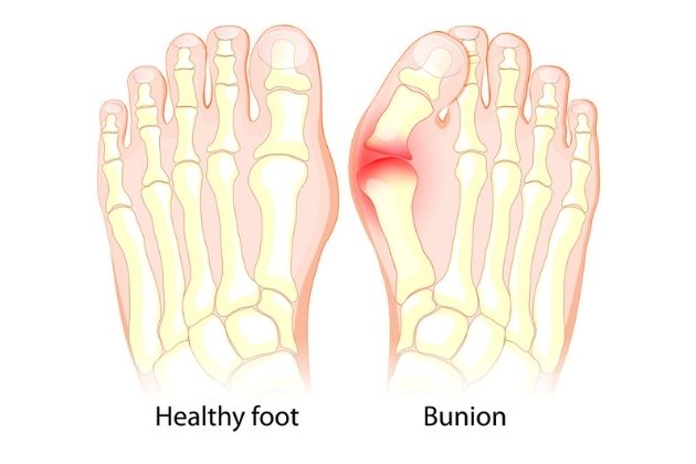 Bunion – Symptoms, Cause and Remedies