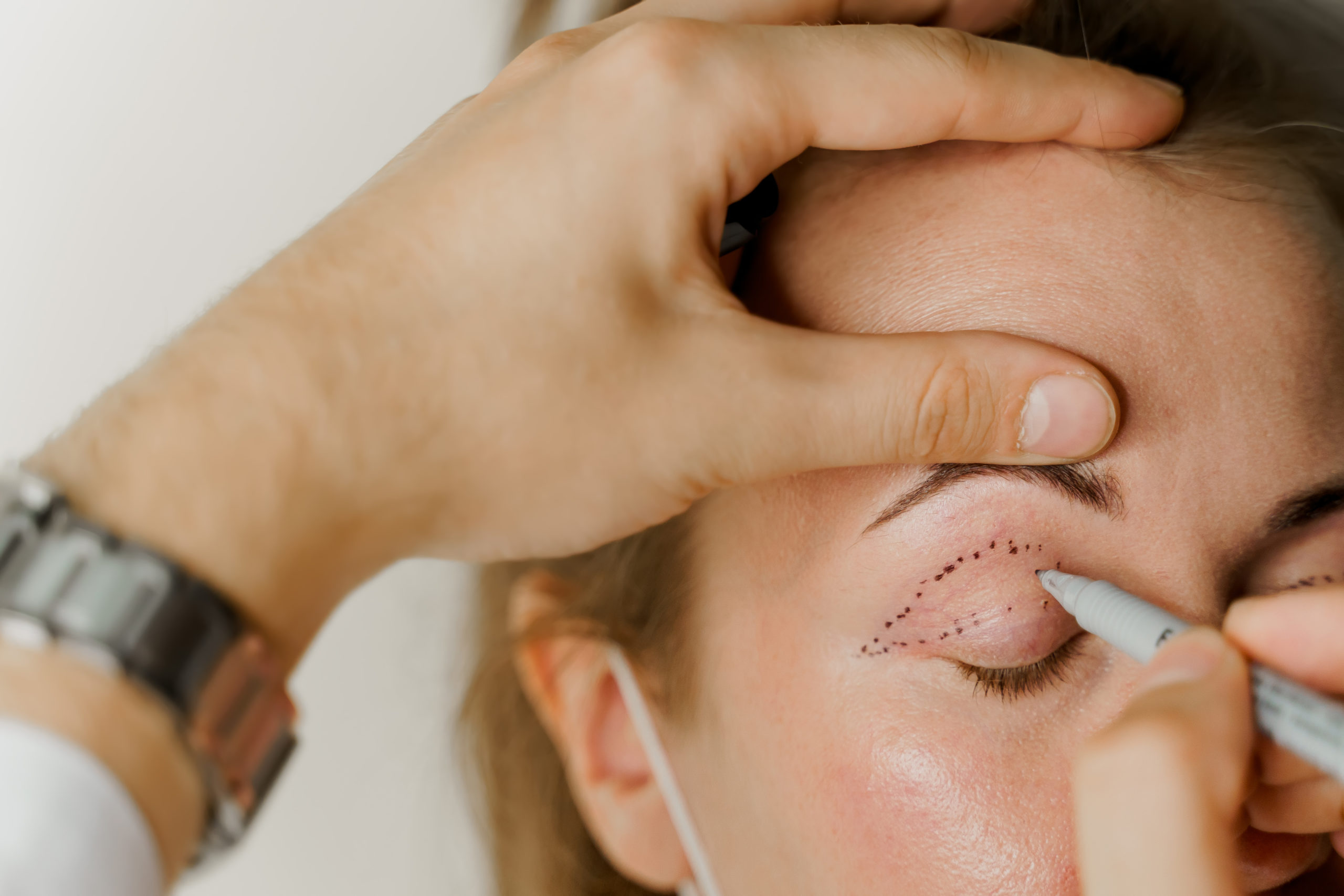 Blepharoplasty Surgery: All You Need to Know