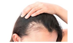 Things to Keep in Mind About Female Pattern Baldness