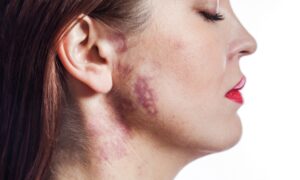 What Are Pigmented Birthmarks? How Are Pigmented Birthmarks Diagnosed?