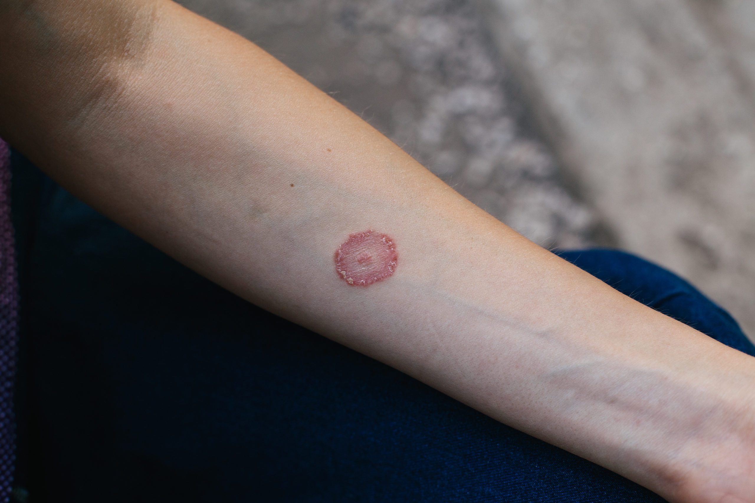 Everything You Want to Know About Ringworm