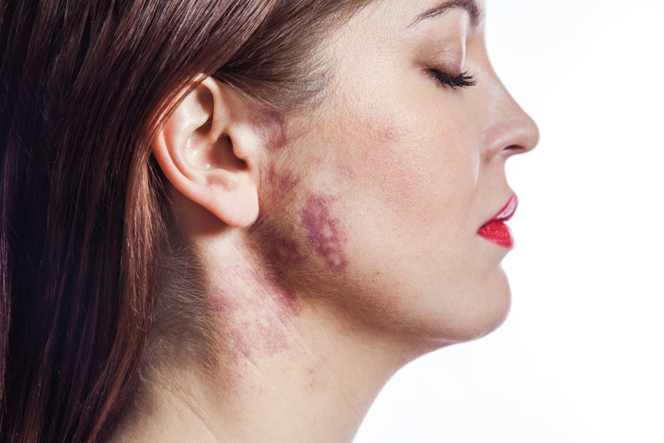 What Are Pigmented Birthmarks? How Are Pigmented Birthmarks Diagnosed?