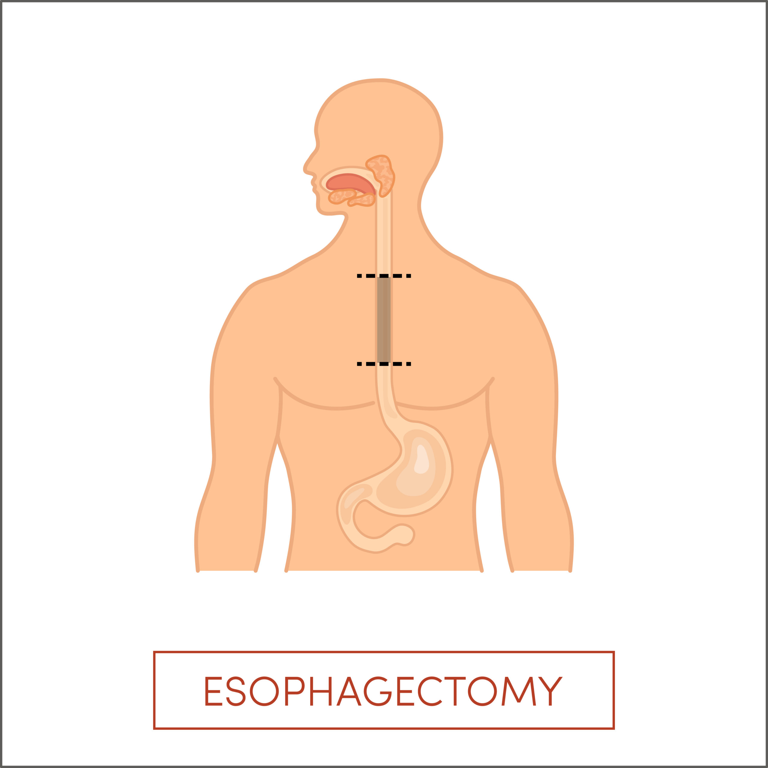 Esophagectomy: Understanding The Procedure