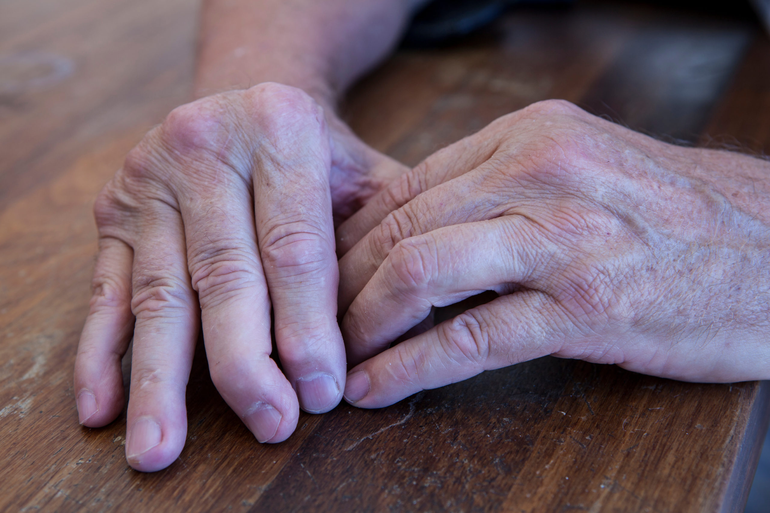 Psoriatic Arthritis: Types Symptoms Causes and Treatments