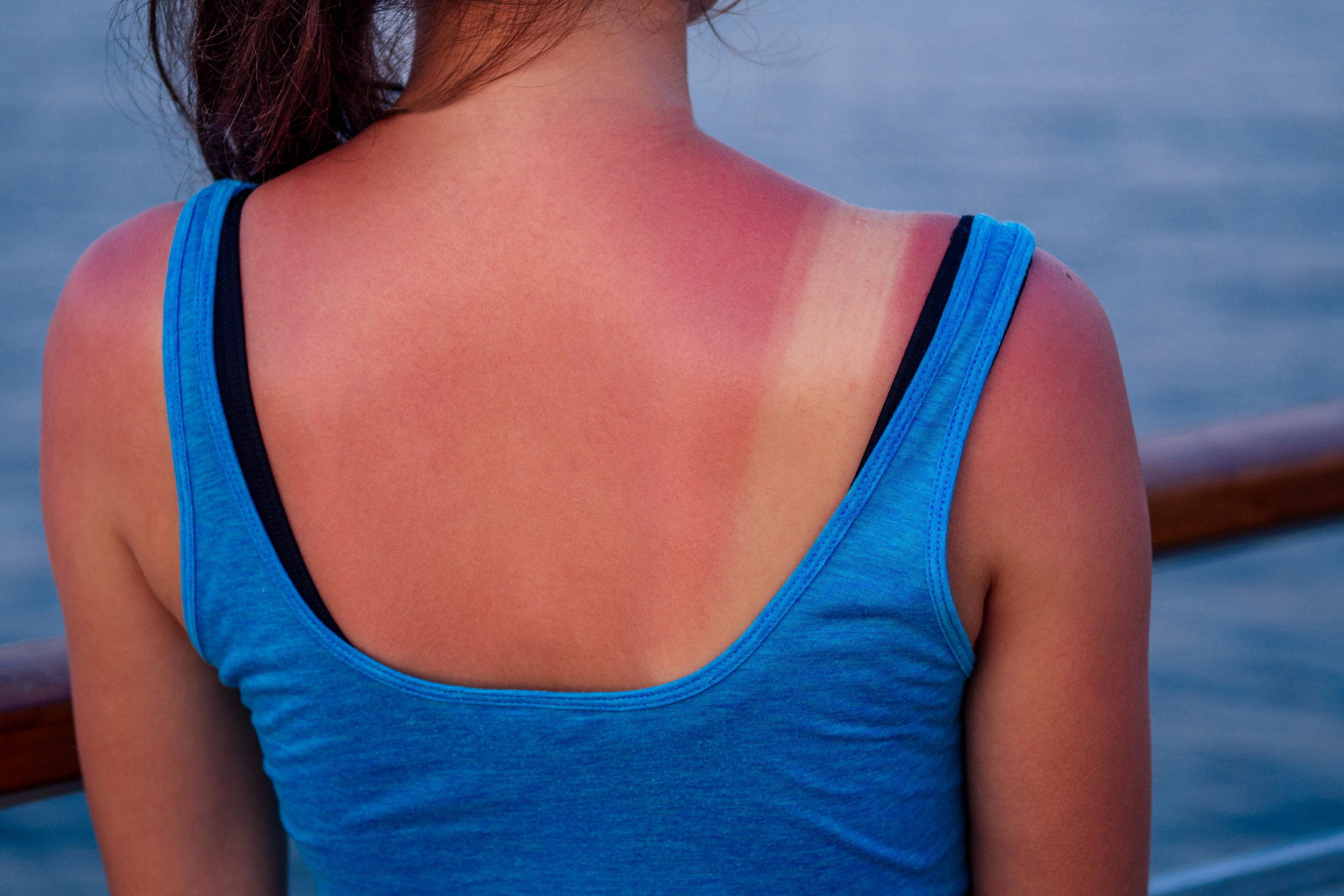 Sunburn: Causes, Symptoms, Home Remedies and Treatment