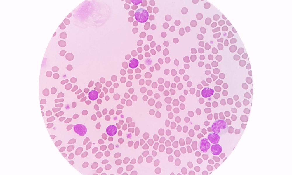 Lymphocytosis (High Lymphocyte Count)-Causes, Symptoms & Treatment