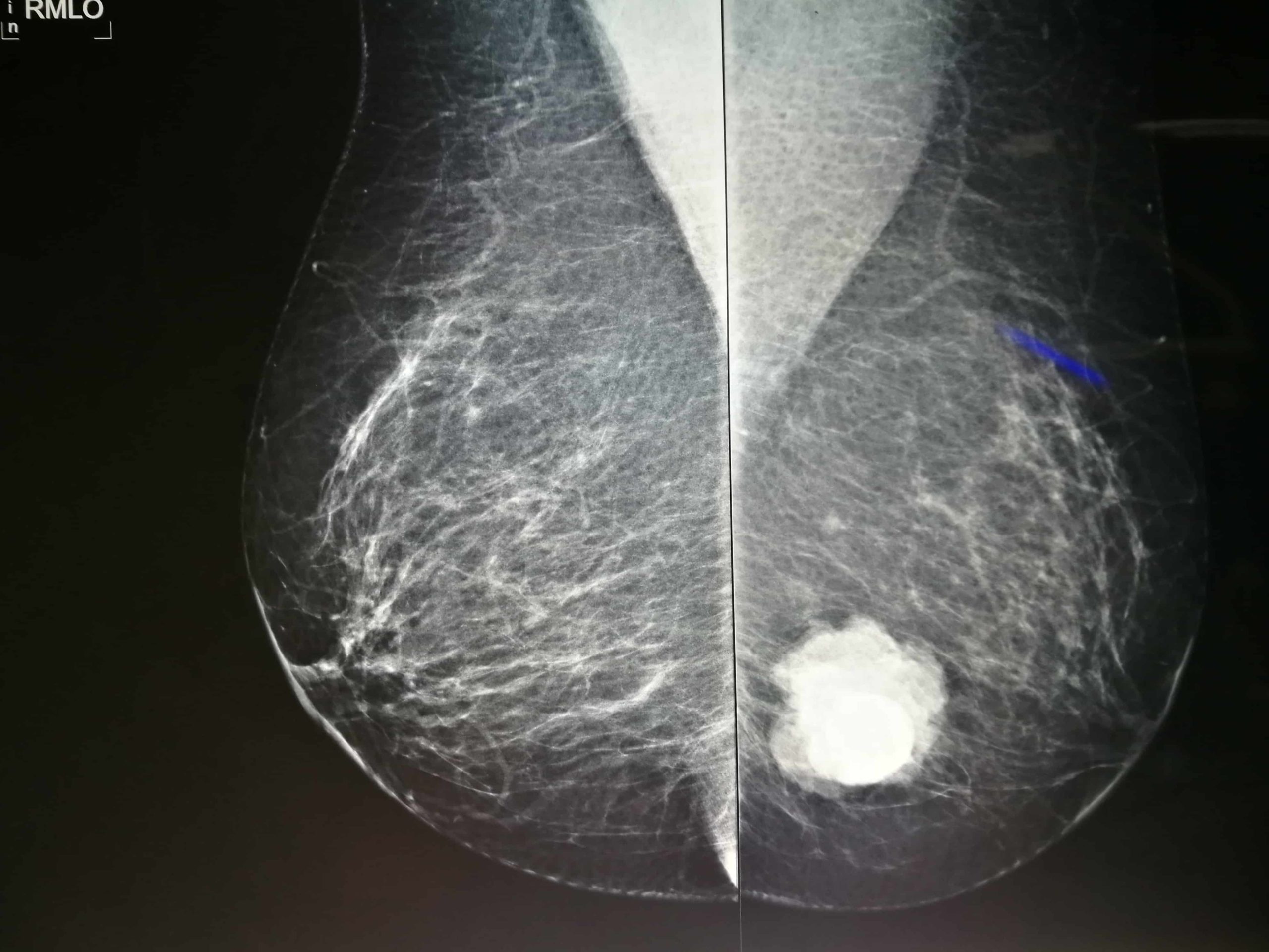 Breast Calcifications – Symptoms, Causes And Treatment