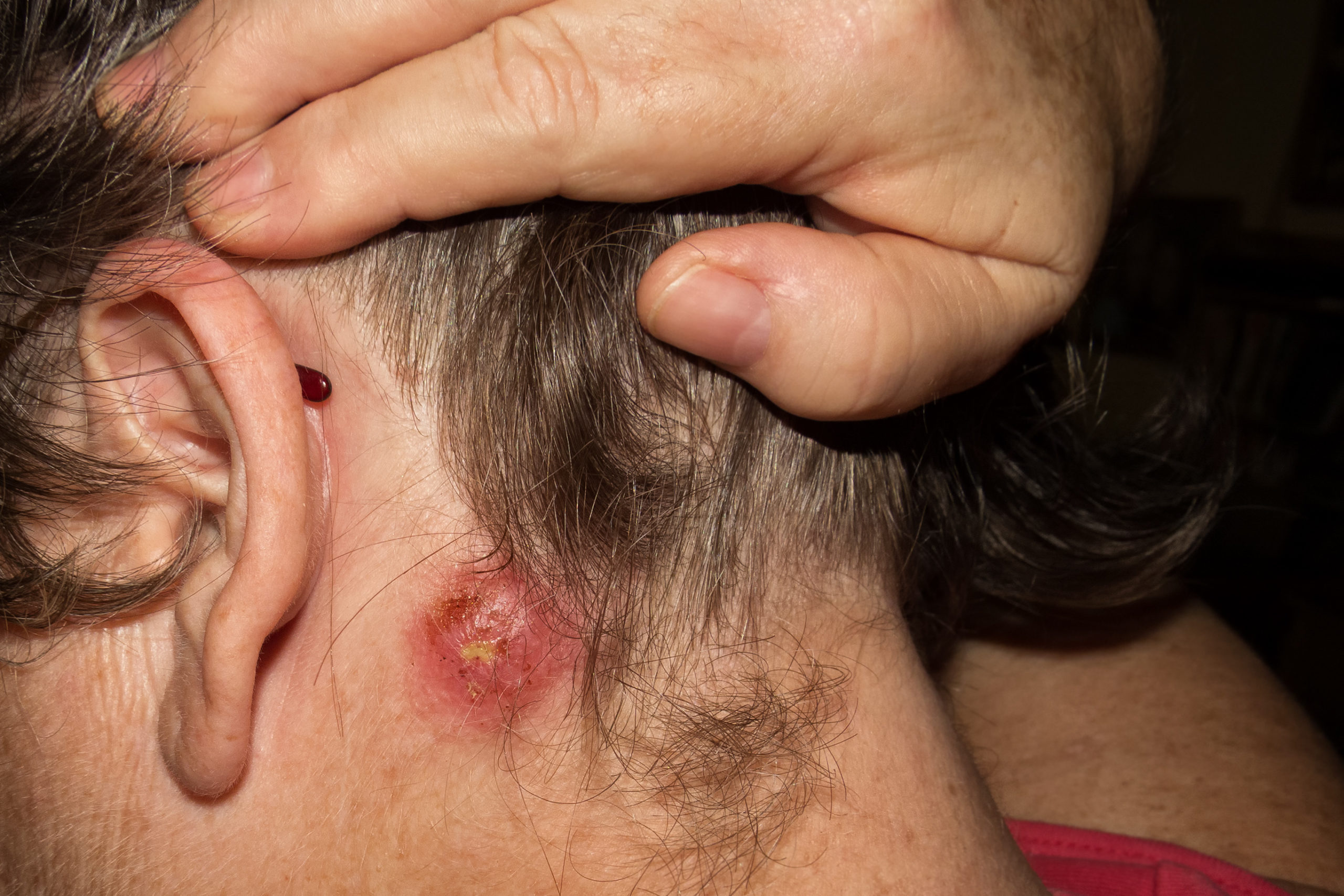 Staph Infections: Symptoms, Causes, Treatment