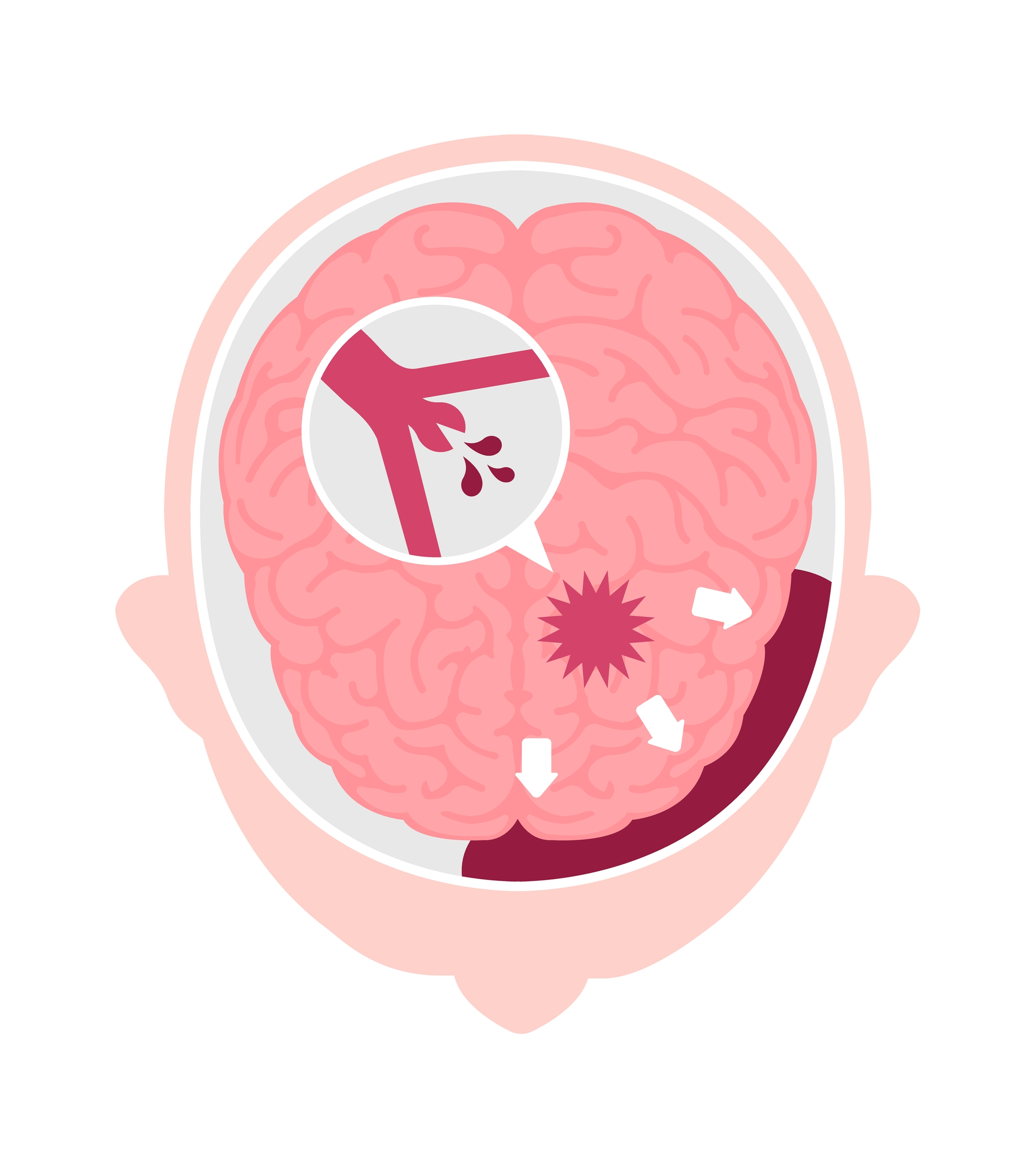 Subarachnoid Hemorrhage