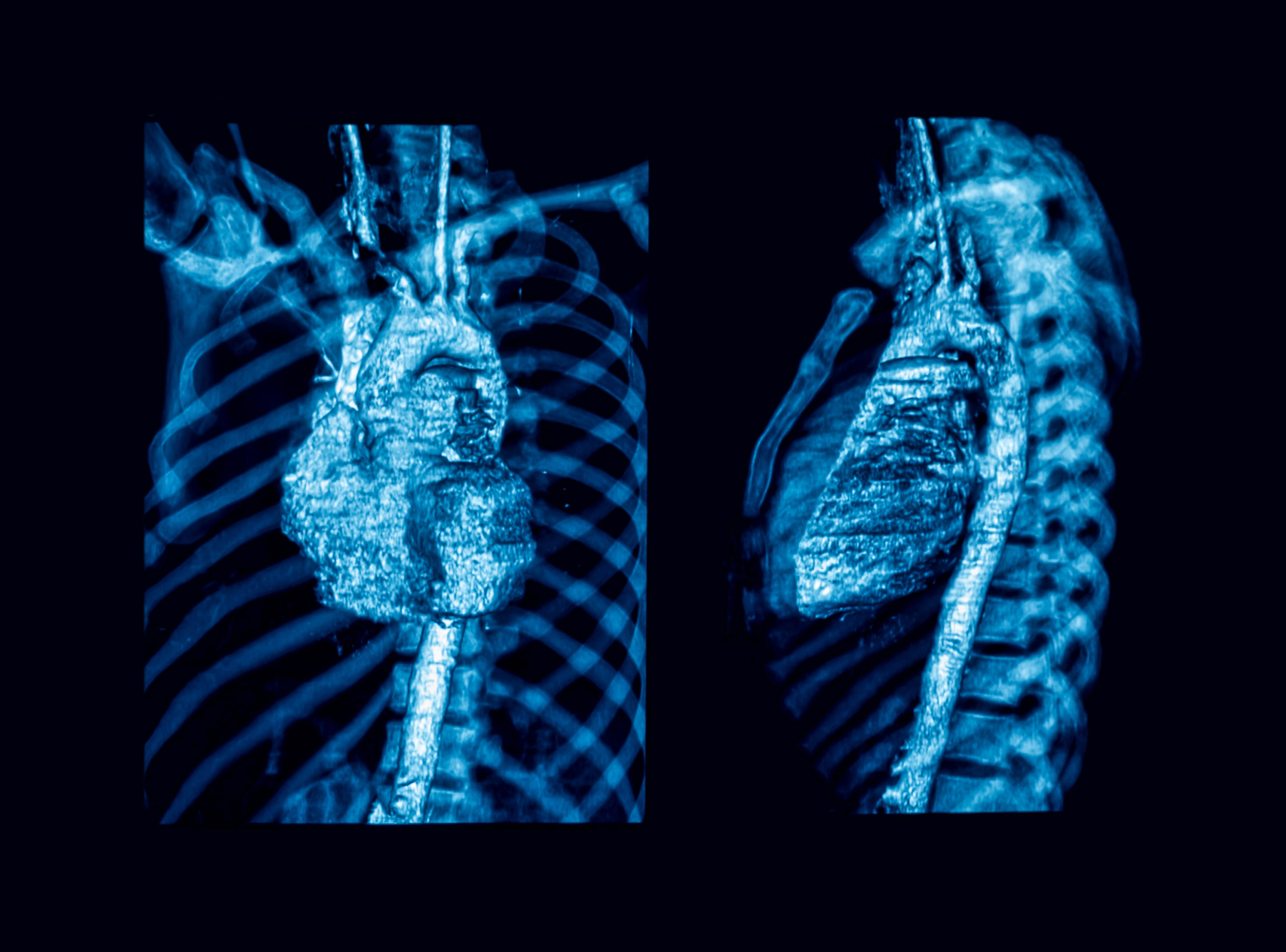 Takayasu’s Arteritis