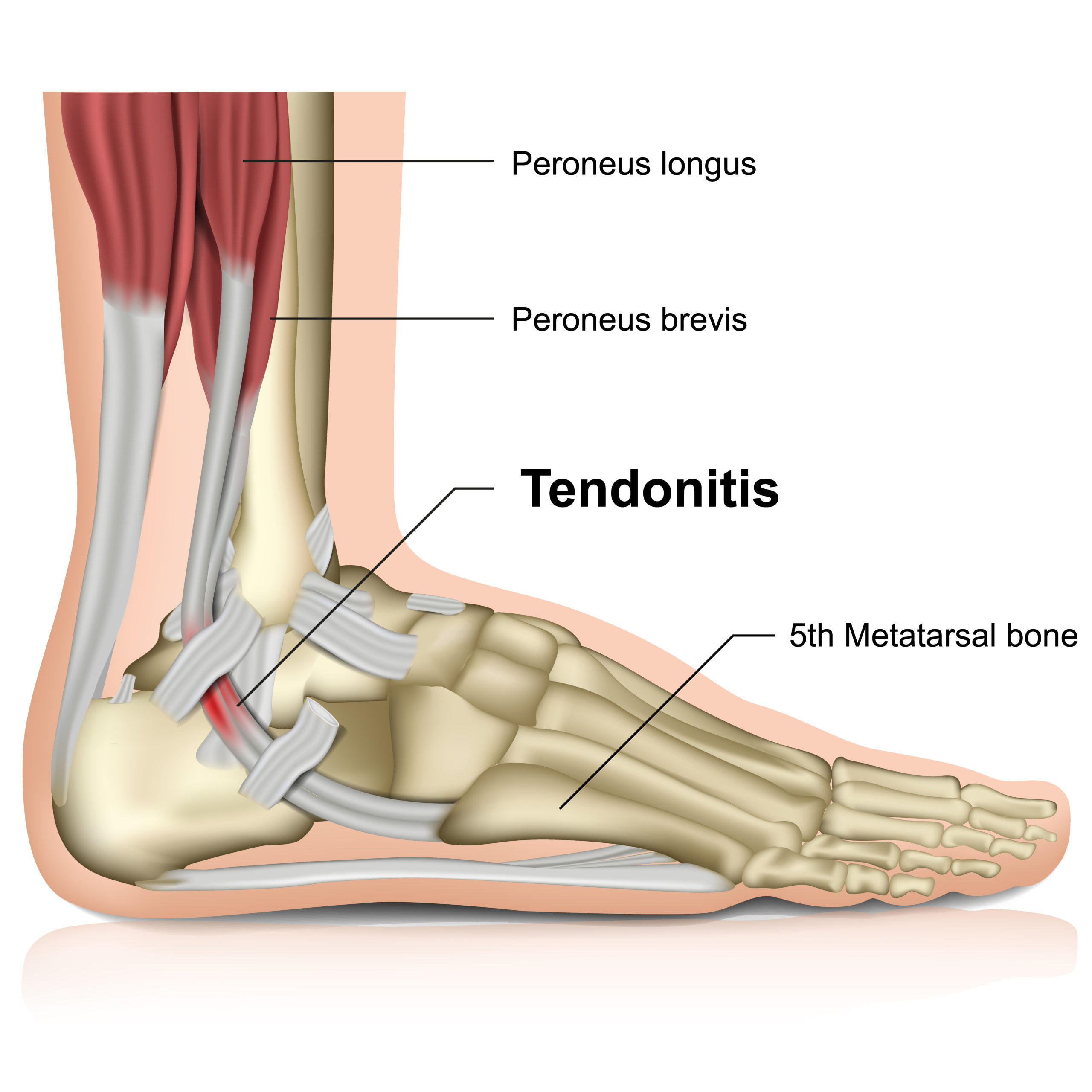 Tendinitis