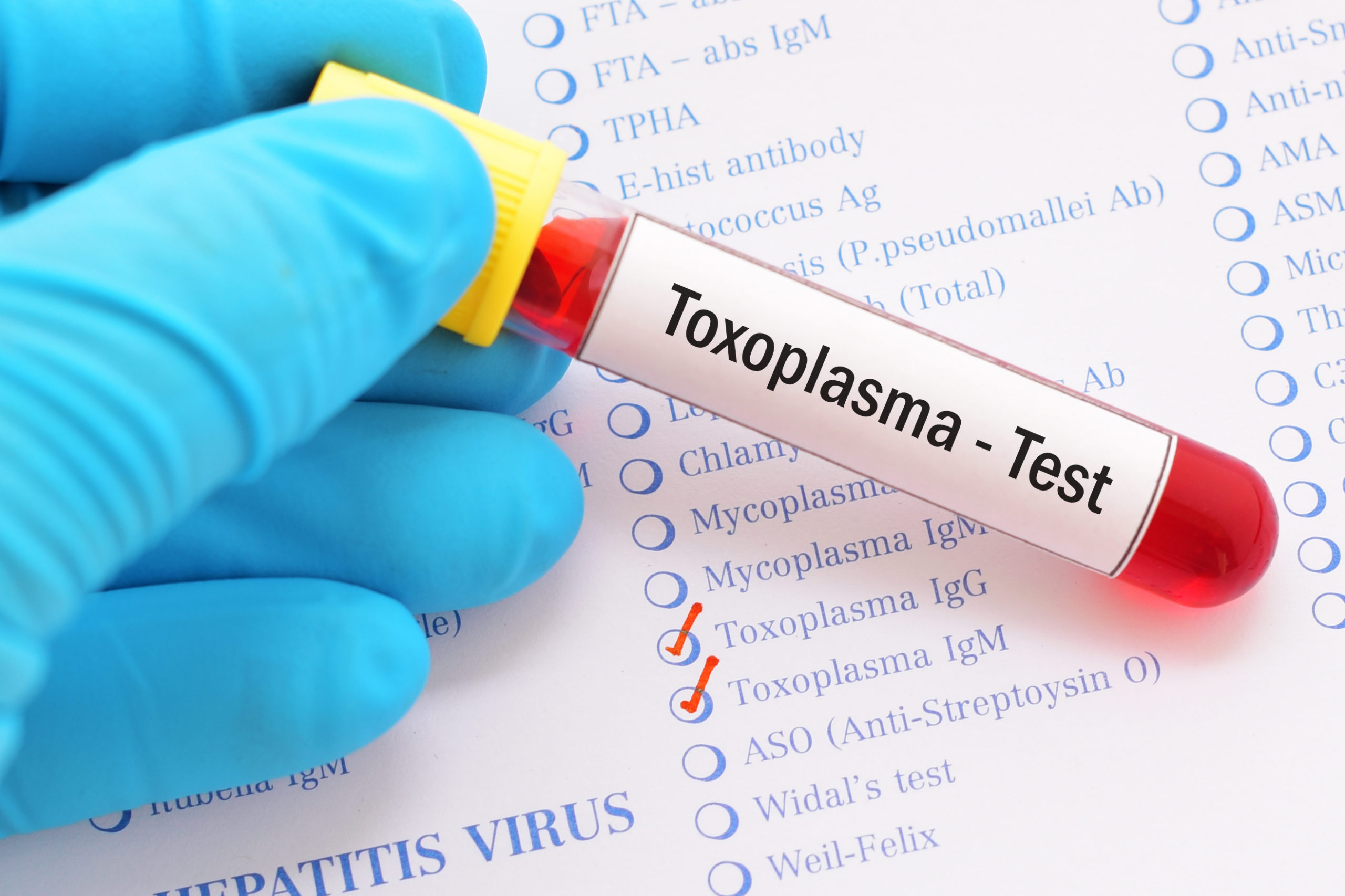 Understanding Toxoplasmosis: Symptoms, Causes and Diagnosis and Treatment Options