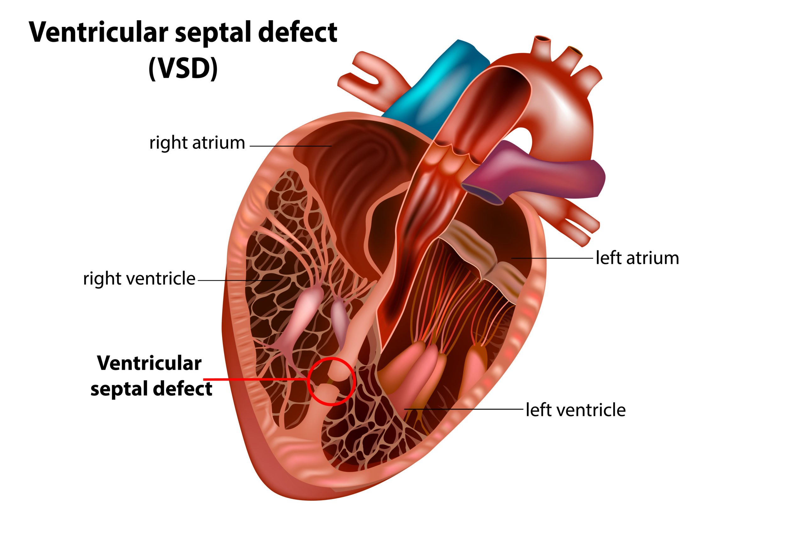 Ventricular Septal Defect (VSD)