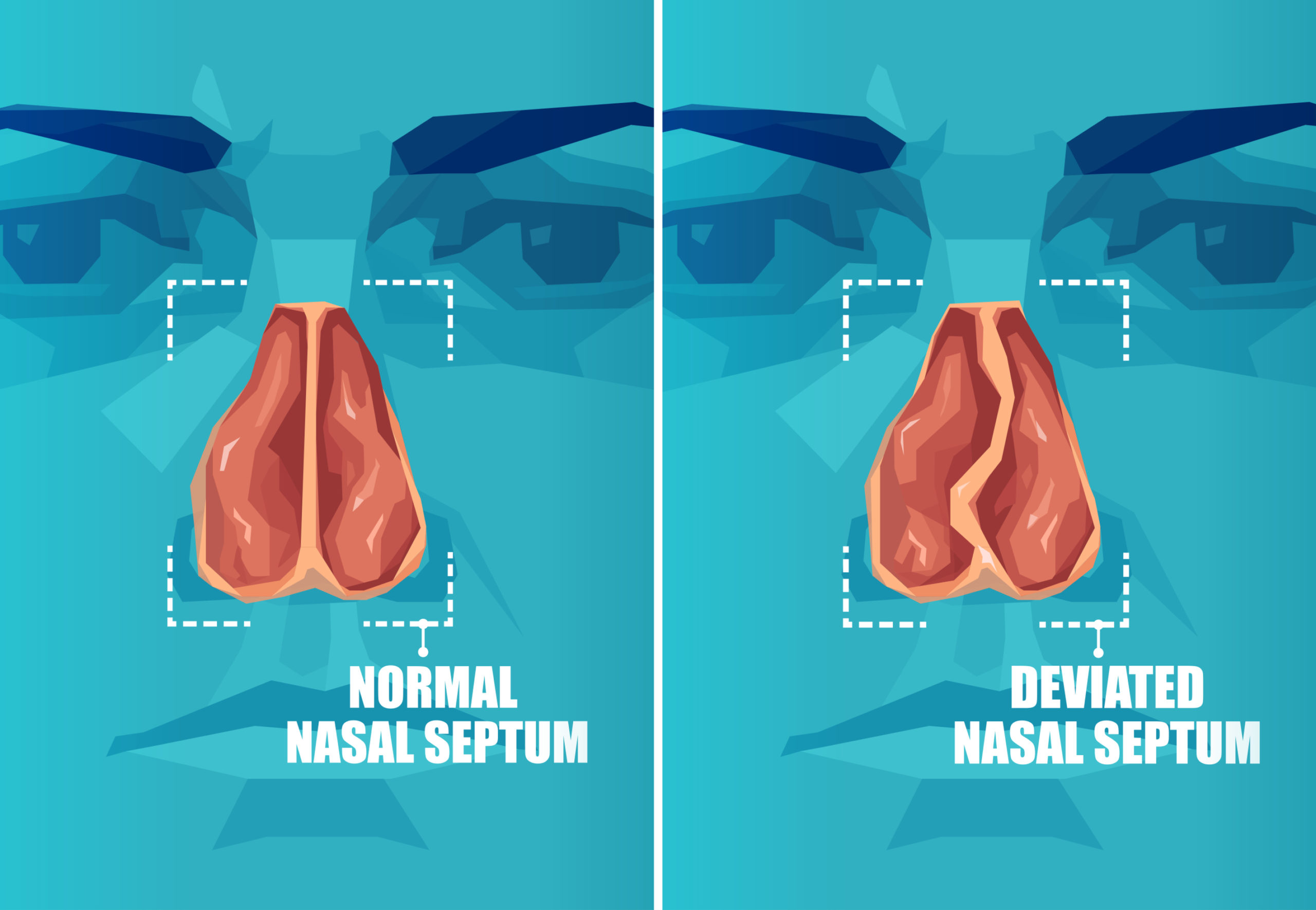 Nasal Septum Deviation – Symptoms, Causes & Treatment