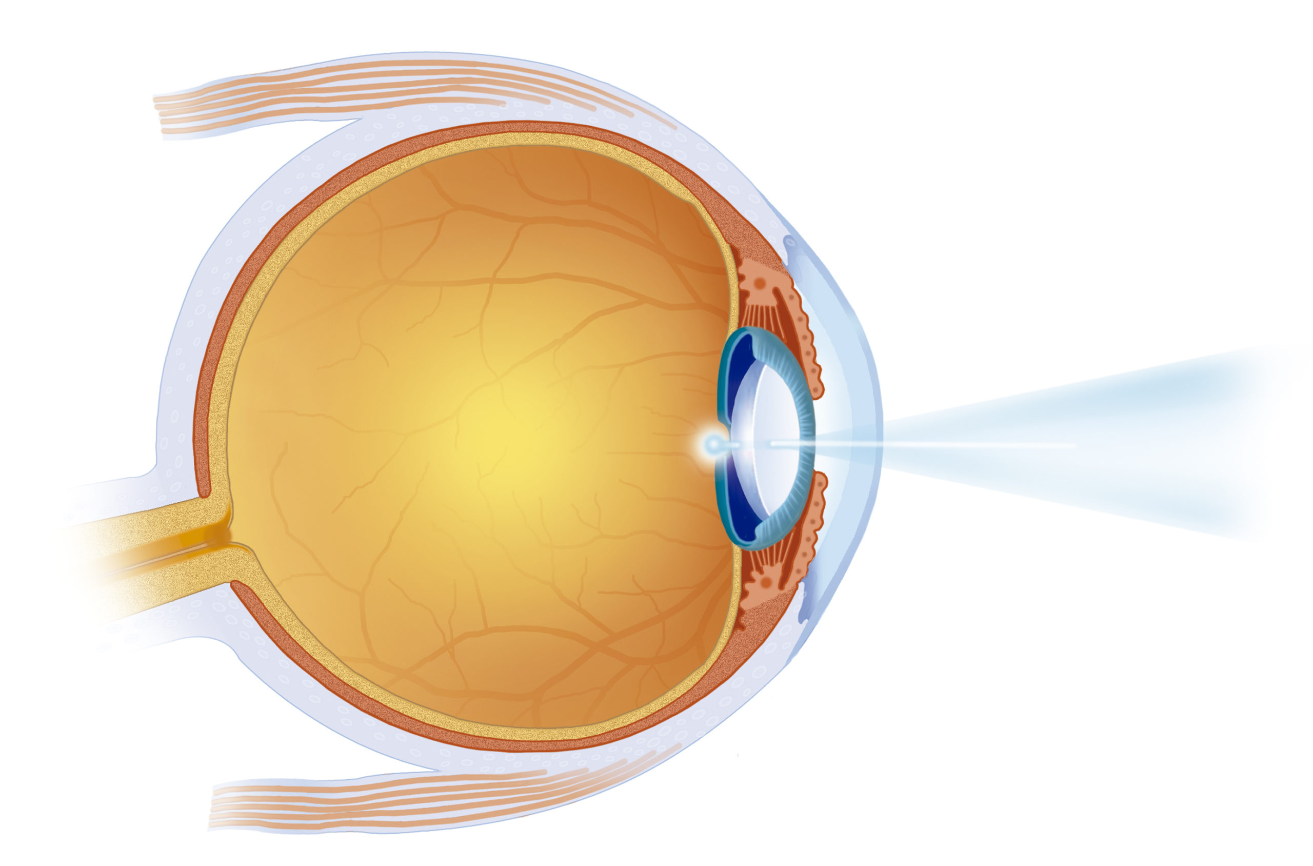 Wet Macular Degeneration