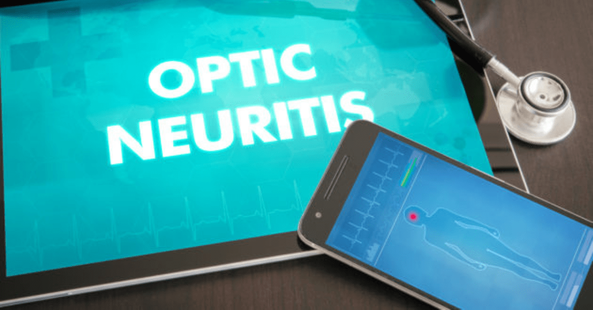 Optic Neuritis – Causes, Symptoms and Treatment