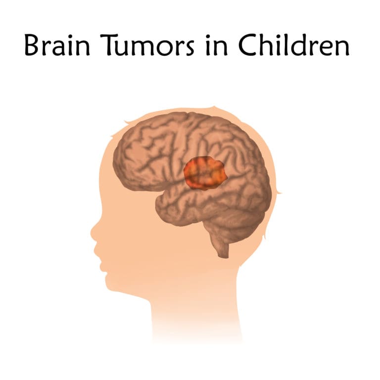 Pediatric Brain Tumor – Causes, Symptoms and Treatment