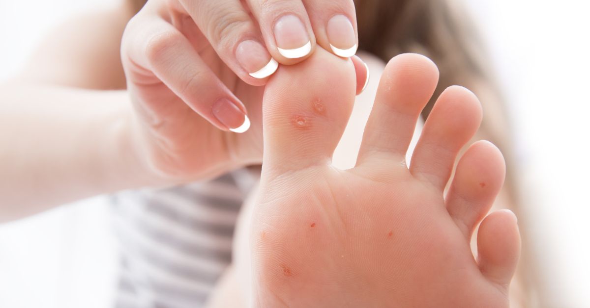 Plantar Warts Symptoms,  Prevent And Treatment